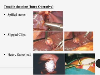 Trouble shooting (Intra Operative)
• Spilled stones
• Slipped Clips
• Heavy Stone load
 