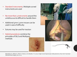 Bhandarkar, D., Mittal, G., Shah, R., Katara, A., & Udwadia, T. E. (2011). Single-incision laparoscopic cholecystectomy: How I do it? Journal of
Minimal Access Surgery, 7(1), 17–23.
• Standard instruments / Multiple curved
instruments are used
• No more than 3 instruments around the
umbilicus as its difficult to handle them
• Additional 3mm / 5mm trocars can be
used in case of difficulty
• Sutures may be used for traction
• Hybrid procedures combine the
principles of SILS and Multiport
methods
 