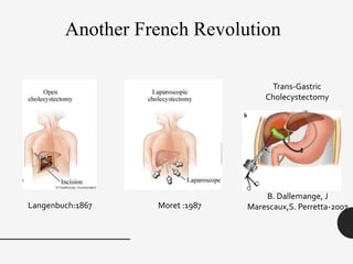 Another French Revolution
Langenbuch:1867 Moret :1987
B. Dallemange, J
Marescaux,S. Perretta-2007
Trans-Gastric
Cholecystectomy
 