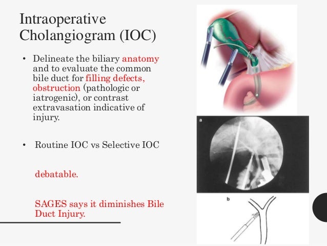 Laparoscopic Cholecystectomy laparoscopic-cholecystectomy