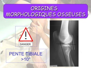 ORIGINES  MORPHOLOGIQUES OSSEUSES DANGER PENTE TIBIALE >10° 