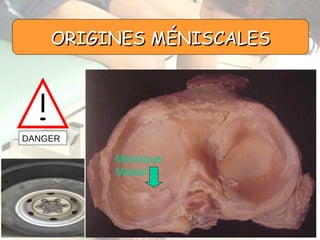 Ménisque Médial ORIGINES MÉNISCALES DANGER 