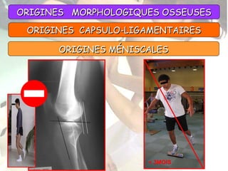ORIGINES  MORPHOLOGIQUES OSSEUSES ORIGINES MÉNISCALES < 3MOIS ORIGINES  CAPSULO-LIGAMENTAIRES 