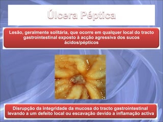 Lesão, geralmente solitária, que ocorre em qualquer local do tracto gastrointestinal exposto à acção agressiva dos sucos ácidos/pépticos Disrupção da integridade da mucosa do tracto gastrointestinal  levando a um defeito local ou escavação devido a inflamação activa 