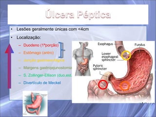 Lesões geralmente únicas com <4cm Localização: Duodeno (1ªporção) Estômago (antro) Junção gastroesofágica Margens gastrojejunostomia S. Zollinger-Ellison (duo,est. ou jej.) Divertículo de Meckel 