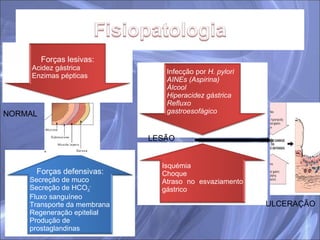 NORMAL LESÃO ULCERAÇÃO Infecção por  H. pylori AINEs (Aspirina) Álcool Hiperacidez gástrica Refluxo gastroesofágico Isquémia Choque Atraso no esvaziamento gástrico Forças defensivas: Secreção de muco Secreção de HCO 3 - Fluxo sanguíneo Transporte da membrana Regeneração epitelial Produção de prostaglandinas Forças lesivas: Acidez gástrica Enzimas pépticas 