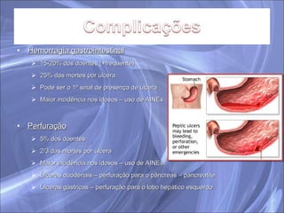 Hemorragia gastrointestinal 15-20% dos doentes (+frequente) 25% das mortes por úlcera Pode ser o 1º sinal de presença de úlcera Maior incidência nos idosos – uso de AINEs Perfuração 5% dos doentes 2/3 das mortes por úlcera Maior incidência nos idosos – uso de AINEs Úlceras duodenais – perfuração para o pâncreas – pancreatite Úlceras gástricas – perfuração para o lobo hepático esquerdo 