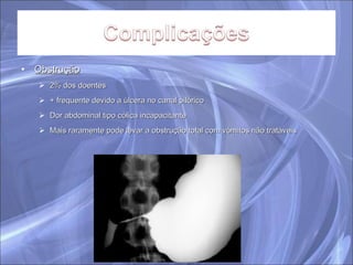 Obstrução 2% dos doentes + frequente devido a úlcera no canal pilórico Dor abdominal tipo cólica incapacitante Mais raramente pode levar a obstrução total com vómitos não tratáveis 