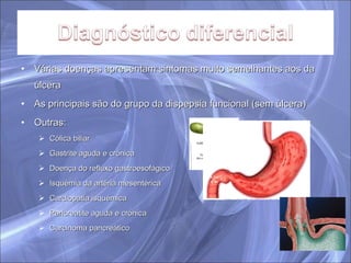 Várias doenças apresentam sintomas muito semelhantes aos da úlcera As principais são do grupo da dispepsia funcional (sem úlcera) Outras: Cólica biliar Gastrite aguda e crónica Doença do refluxo gastroesofágico Isquémia da artéria mesentérica Cardiopatia isquémica Pancreatite aguda e crónica Carcinoma pancreático 