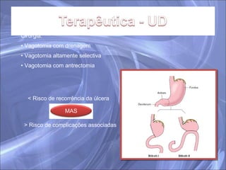 Cirurgia: Vagotomia com drenagem Vagotomia altamente selectiva Vagotomia com antrectomia < Risco de recorrência da úlcera > Risco de complicações associadas MAS 