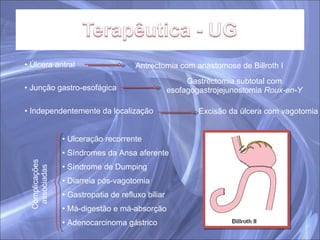 Úlcera antral Antrectomia com anastomose de Billroth I Gastrectomia subtotal com esofagogastrojejunostomia  Roux-en-Y Junção gastro-esofágica Independentemente da localização Excisão da úlcera com vagotomia Ulceração recorrente Síndromes da Ansa aferente Síndrome de Dumping Diarreia pós-vagotomia Gastropatia de refluxo biliar Má-digestão e má-absorção Adenocarcinoma gástrico Complicações associadas 