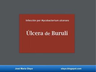 José María Olayo olayo.blogspot.com
Úlcera de Buruli
Infección por Mycobacterium ulcerans
 