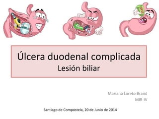 Úlcera duodenal complicada
Lesión biliar
Mariana Loreto Brand
MIR-IV
Santiago de Compostela, 20 de Junio de 2014
 