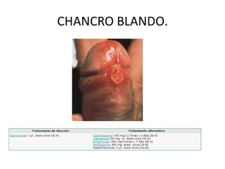 úLcera genital clase (2) | PPTX