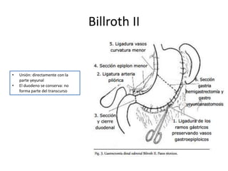 Billroth II
• Unión: directamente con la
parte yeyunal
• El duodeno se conserva: no
forma parte del transcurso
 