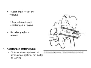 • Buscar ángulo duodeno
yeyunal
• 15 cms abajo sitio de
anastomosis a yeyuno
• No debe quedar a
tensión
• Anastomosis gastroyeyunal:
– El primer plano a realizar es el
seromuscular posterior con puntos
de Cushing
 