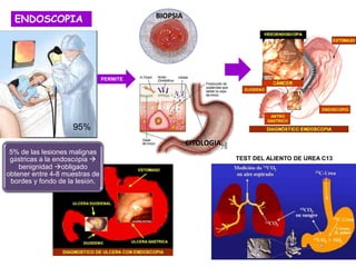ENDOSCOPIA
95%
PERMITE
BIOPSIA
CITOLOGIA
5% de las lesiones malignas
gástricas a la endoscópia 
benignidad obligado
obtener entre 4-8 muestras de
bordes y fondo de la lesión.
TEST DEL ALIENTO DE UREA C13
 