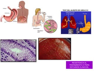 TEST DEL ALIENTO DE UREA C13
RESISTENCIA AL
TRATAMIENTO O PARA
ESTUDIOS CLÍNICOS.
 