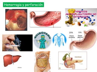 Hemorragia y perforación
25% 15%
 