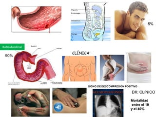5%
Bulbo duodenal
90%
CLÍNICA:
SIGNO DE DESCOMPRESIÓN POSITIVO
DX: CLÍNICO
Mortalidad
entre el 10
y el 40%.
 