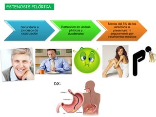 ESTENOSIS PILÓRICA
Secundaria a
procesos de
cicatrización
Retracción en úlceras
pilóricas y
duodenales
Menos del 5% de los
ulcerosos la
presentan , 
seguramente por
tratamientos médicos
DX:
 