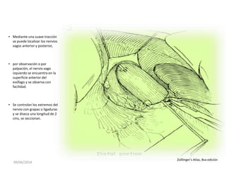09/06/2014
Zolllinger’s Atlas, 8va edición
• Mediante una suave tracción
se puede localizar los nervios
vagos anterior y posterior,
• por observación o por
palpación, el nervio vago
izquierdo se encuentra en la
superficie anterior del
esófago y se observa con
facilidad.
• Se controlan los extremos del
nervio con grapas o ligaduras
y se diseca una longitud de 2
cms, se seccionan.
 