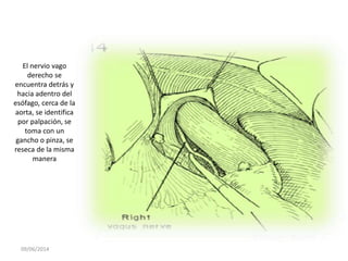 09/06/2014
El nervio vago
derecho se
encuentra detrás y
hacia adentro del
esófago, cerca de la
aorta, se identifica
por palpación, se
toma con un
gancho o pinza, se
reseca de la misma
manera
 