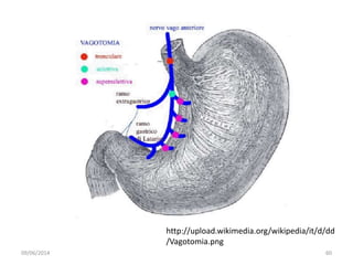 09/06/2014 60
http://upload.wikimedia.org/wikipedia/it/d/dd
/Vagotomia.png
 