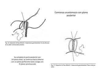Comienza anastomosis con plano
posterior
Se completa la parte posterior con
Un plano total, se continua hacia anterior
con un plano perforante total y luego con
El plano seromuscular
 