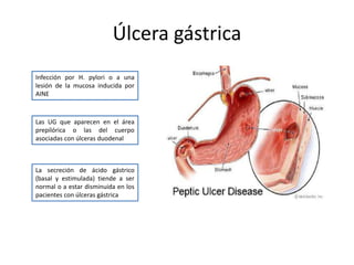 Úlcera gástrica
Infección por H. pylori o a una
lesión de la mucosa inducida por
AINE
Las UG que aparecen en el área
prepilórica o las del cuerpo
asociadas con úlceras duodenal
La secreción de ácido gástrico
(basal y estimulada) tiende a ser
normal o a estar disminuida en los
pacientes con úlceras gástrica
 