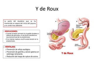Y de Roux
La parte del duodeno que se ha
mantenido se separa del inicio del yeyuno
y es unida mas adelante
 