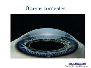 Úlceras corneales




                    www.bittelman.cl
                Doctor Ricardo Bittelman
 