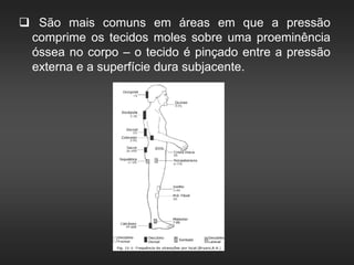  São mais comuns em áreas em que a pressão
comprime os tecidos moles sobre uma proeminência
óssea no corpo – o tecido é pinçado entre a pressão
externa e a superfície dura subjacente.
 