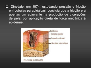  Dinsdale, em 1974, estudando pressão e fricção
em cobaias paraplégicas, concluiu que a fricção era
apenas um adjuvante na produção de ulcerações
de pele, por aplicação direta de força mecânica à
epiderme.
 