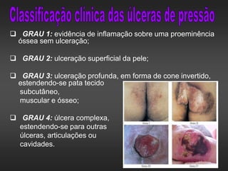  GRAU 1: evidência de inflamação sobre uma proeminência
óssea sem ulceração;
 GRAU 2: ulceração superficial da pele;
 GRAU 3: ulceração profunda, em forma de cone invertido,
estendendo-se pata tecido
subcutâneo,
muscular e ósseo;
 GRAU 4: úlcera complexa,
estendendo-se para outras
úlceras, articulações ou
cavidades.
 