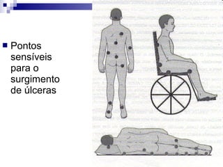  Pontos
sensíveis
para o
surgimento
de úlceras
 