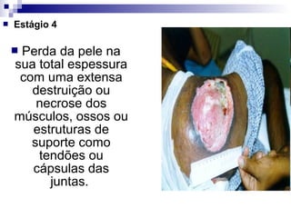  Estágio 4
 Perda da pele na
sua total espessura
com uma extensa
destruição ou
necrose dos
músculos, ossos ou
estruturas de
suporte como
tendões ou
cápsulas das
juntas.
 