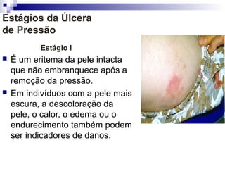 Estágios da Úlcera
de Pressão
Estágio I
 É um eritema da pele intacta
que não embranquece após a
remoção da pressão.
 Em indivíduos com a pele mais
escura, a descoloração da
pele, o calor, o edema ou o
endurecimento também podem
ser indicadores de danos.
 