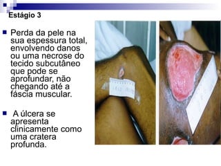 Estágio 3
 Perda da pele na
sua espessura total,
envolvendo danos
ou uma necrose do
tecido subcutâneo
que pode se
aprofundar, não
chegando até a
fáscia muscular.
 A úlcera se
apresenta
clinicamente como
uma cratera
profunda.
 