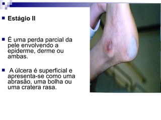  Estágio II
 É uma perda parcial da
pele envolvendo a
epiderme, derme ou
ambas.
 A úlcera é superficial e
apresenta-se como uma
abrasão, uma bolha ou
uma cratera rasa.
 