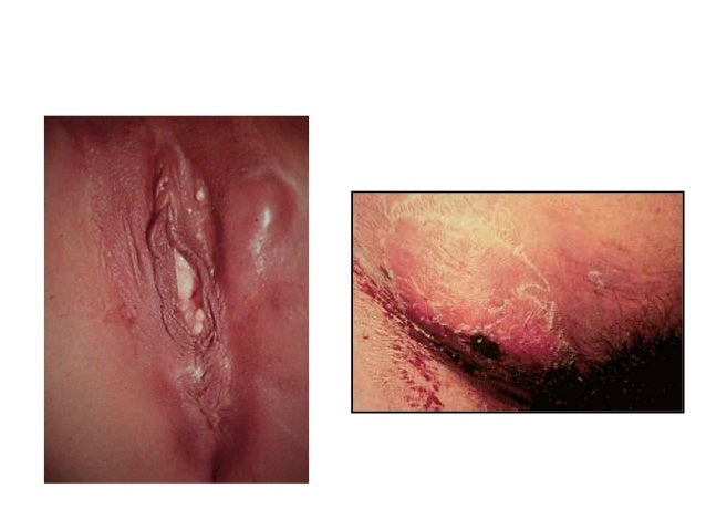 Pictures of STDs: Herpes, Genital Warts, Gonorrhea, STD ...