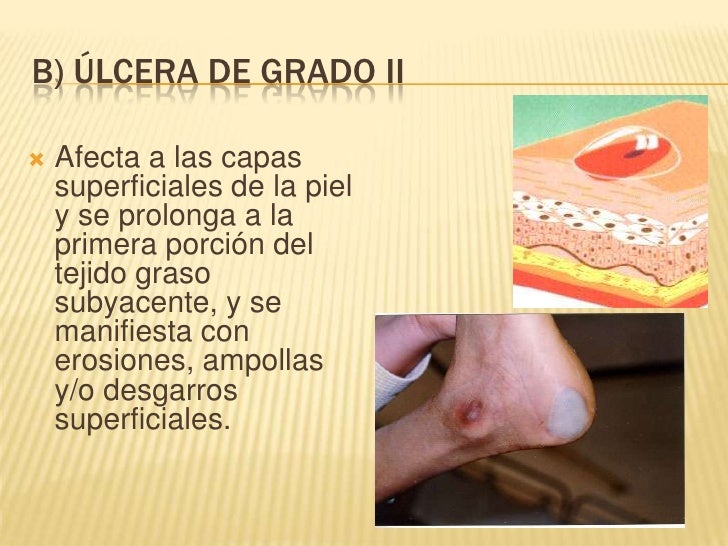 Ulceras por presión