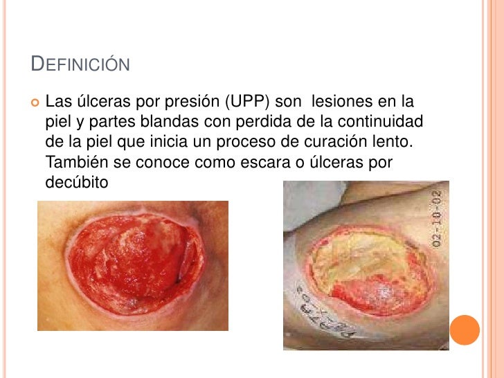 Fotos De Ulceras De Presion by 218 Lceras Por Presi 243 N