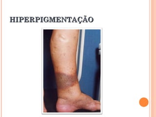 HIPERPIGMENTAÇÃO
 