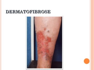 DERMATOFIBROSE
 