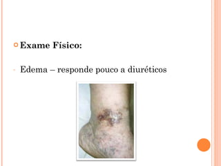  Exame    Físico:

-   Edema – responde pouco a diuréticos
 