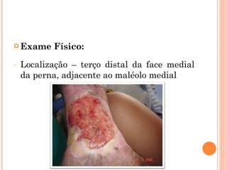  Exame    Físico:
-   Localização – terço distal da face medial
    da perna, adjacente ao maléolo medial
 