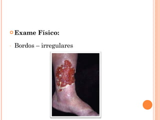  Exame     Físico:
-   Bordos – irregulares
 