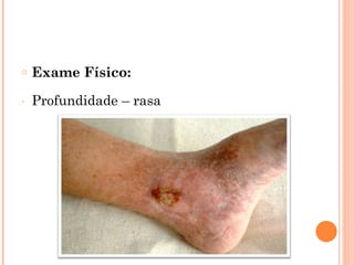 o   Exame Físico:
-   Profundidade – rasa
 