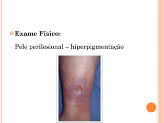  Exame     Físico:
-   Pele perilesional – hiperpigmentação
 